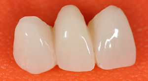 mosty protetyczne mosty protetyczne