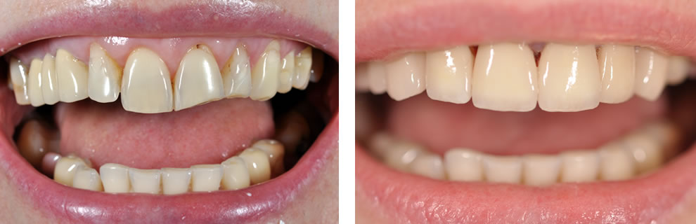 Licówki przed i po Licówki porcelanowe przed i po Ursynów