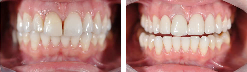 Licówki przed i po Licówki porcelanowe przed i po