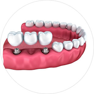 Protetyka Protetyka - protezy zębowe Ursynów