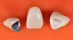 korony protetyczne korony protetyczne