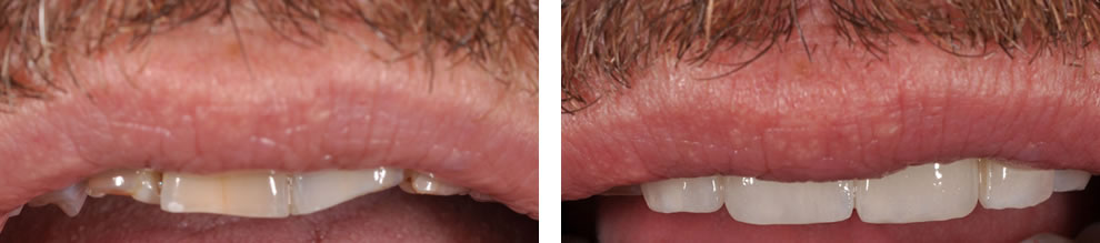 Korony przed i po Korony przed i po