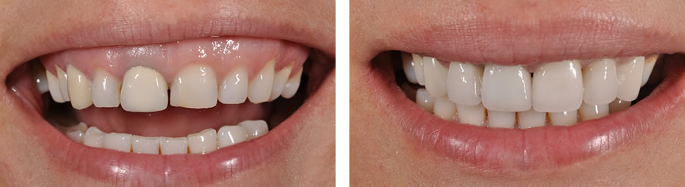 Korony przed i po Korony przed i po