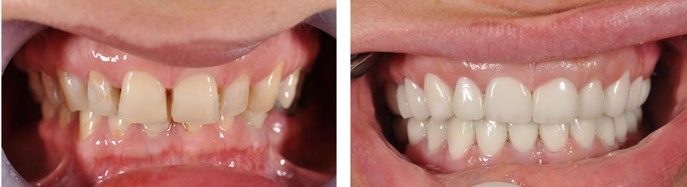 Korony przed i po Korony przed i po