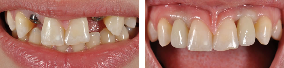 korony na implanatach przed i po korony na implanatach przed i po