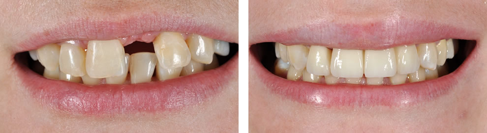 Most przed i po Most przed i po